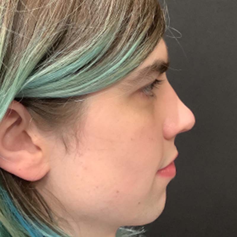 Facial Feminization 05