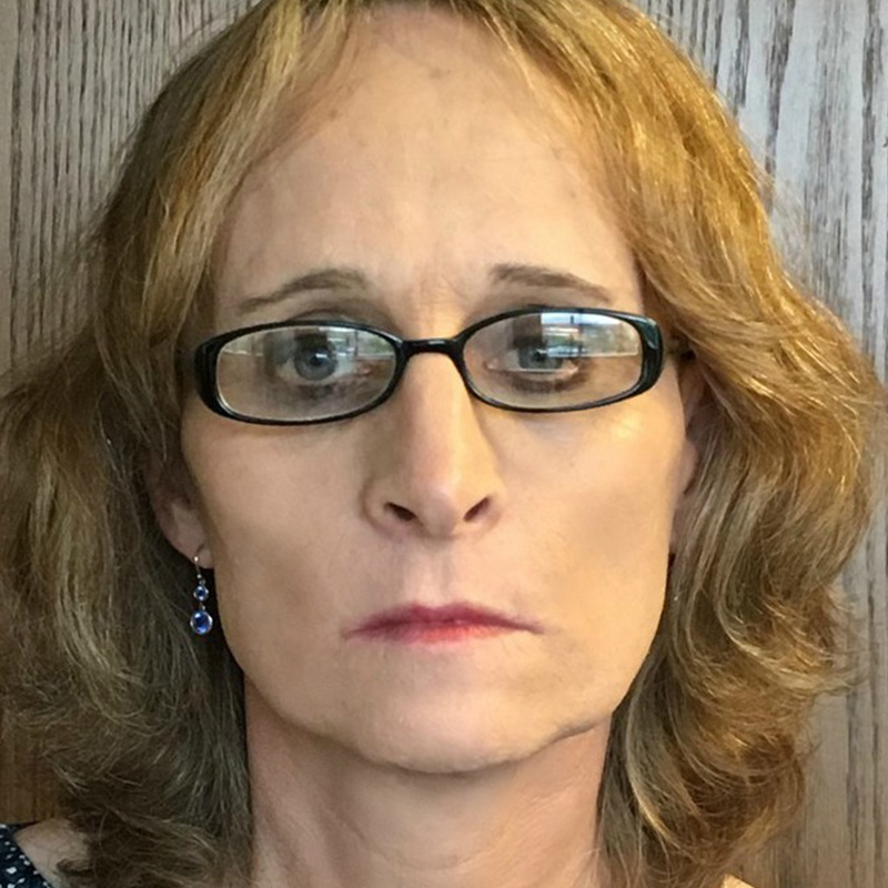 Facial Feminization 06