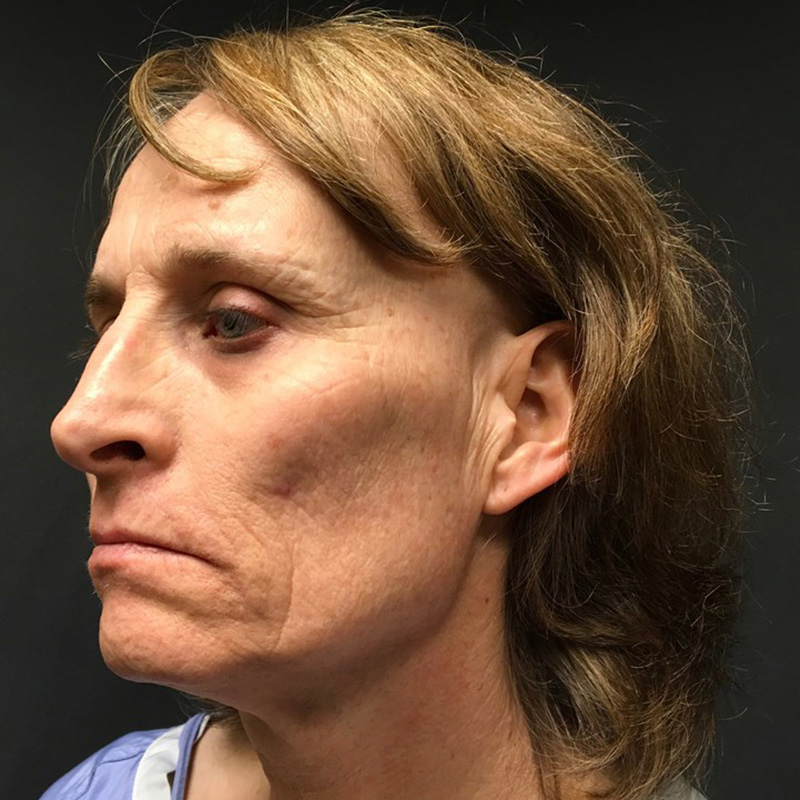 Facial Feminization 05