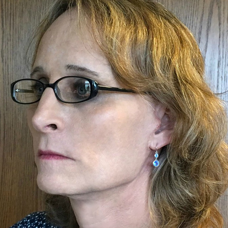 Facial Feminization 05