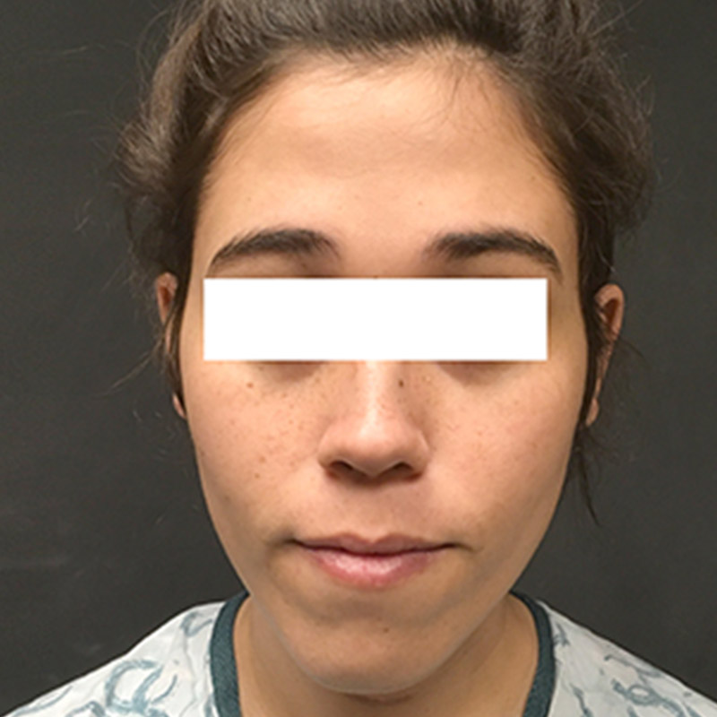 Facial Feminization 01