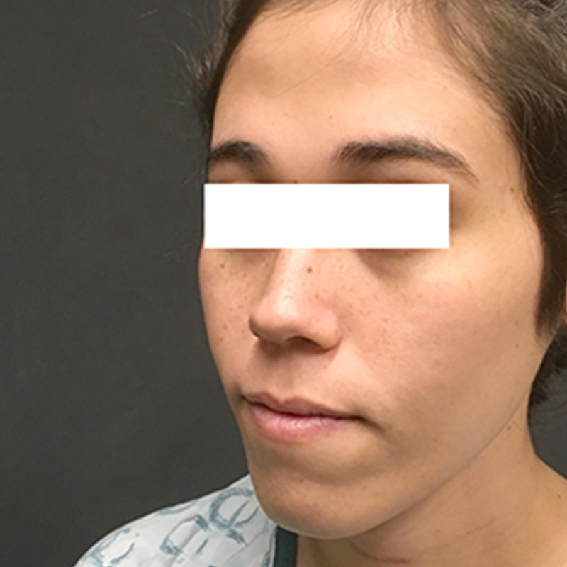 Facial Feminization 03