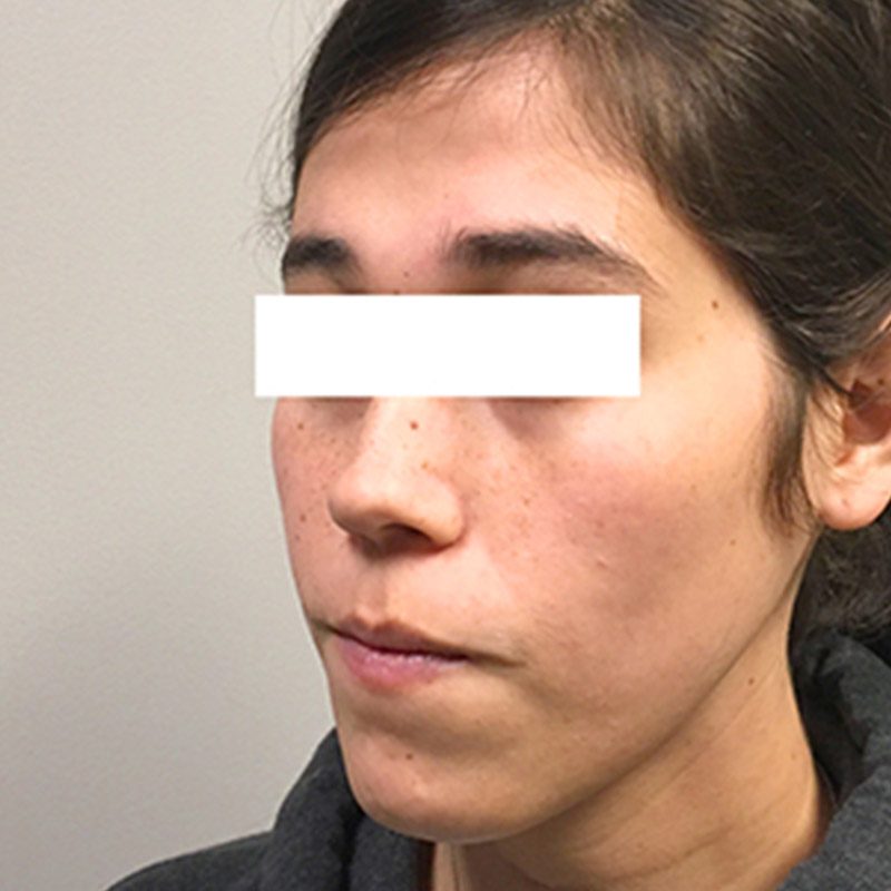 Facial Feminization 03