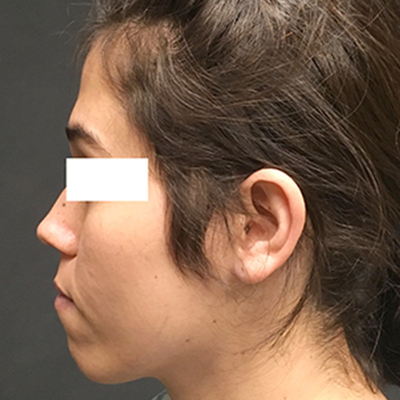 Facial Feminization 05