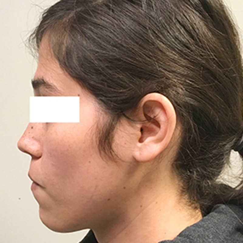 Facial Feminization 05