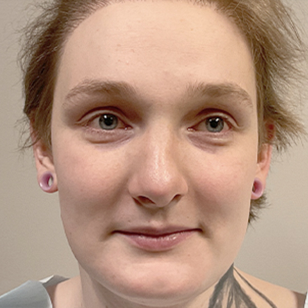 Facial Feminization 09