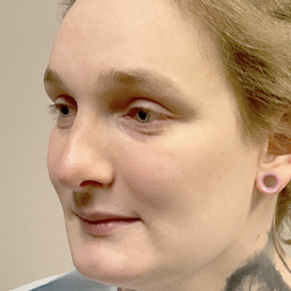 Facial Feminization 03