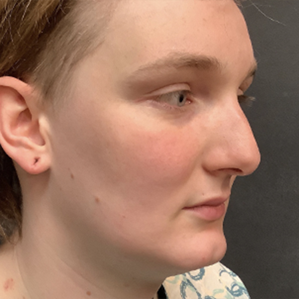 Facial Feminization 07