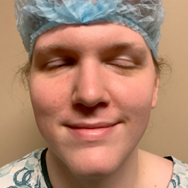 Facial Feminization 01