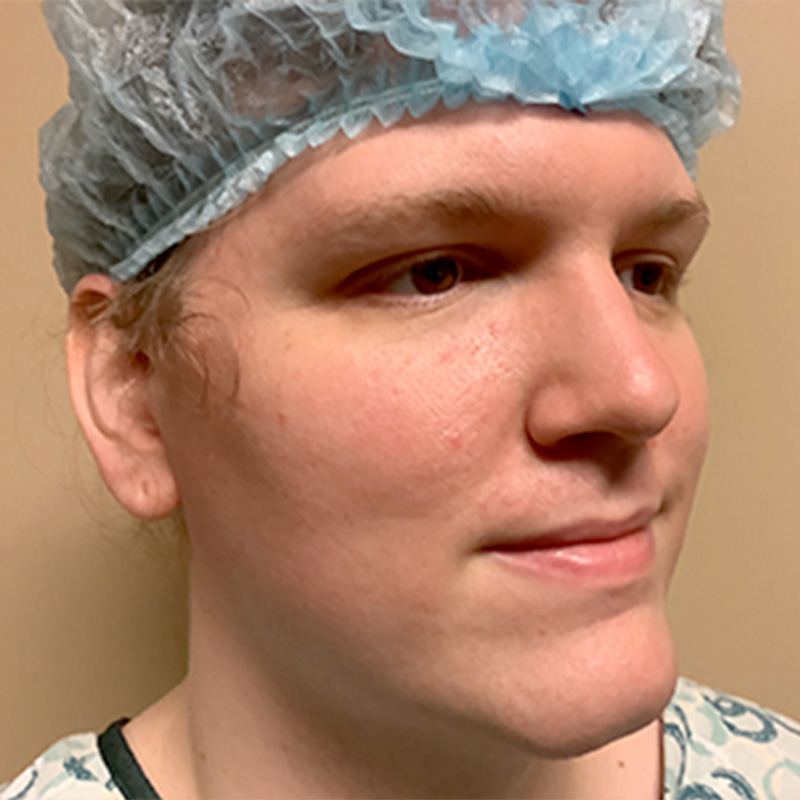 Facial Feminization 03