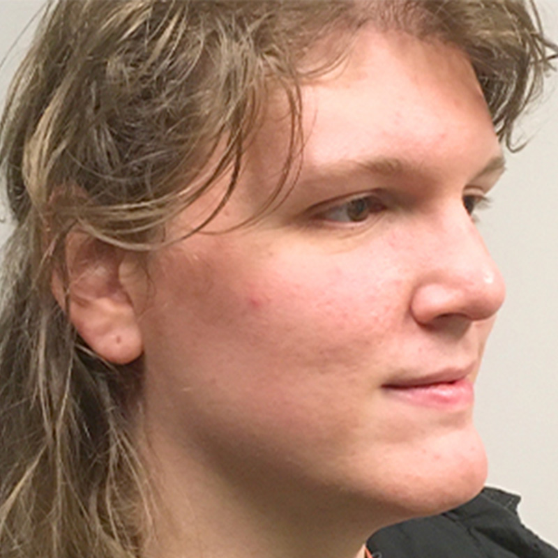 Facial Feminization 03