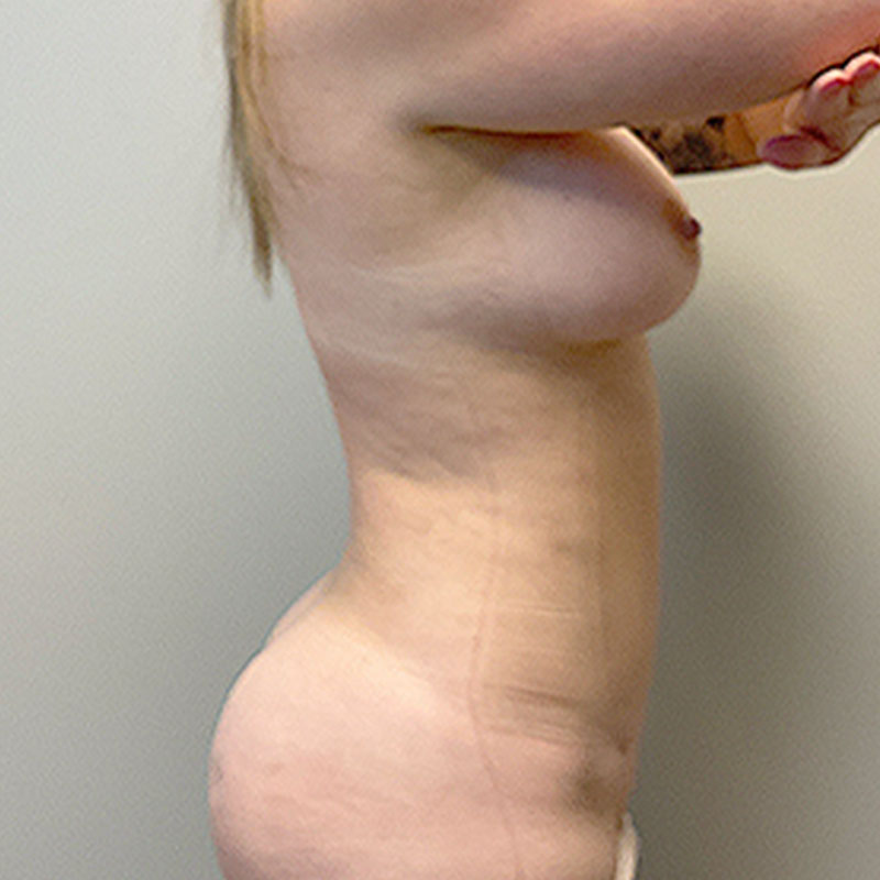 Fat Transfer To Breast 09