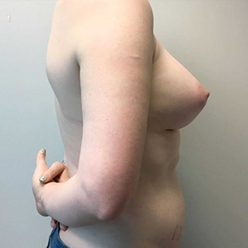 Fat Transfer To Breast 07
