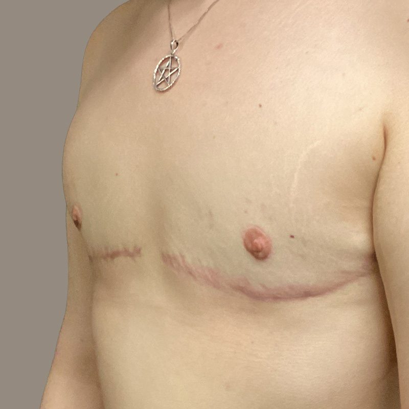 Female To Male Top Surgery 03