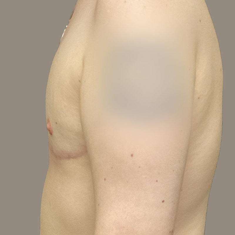 Female To Male Top Surgery 05