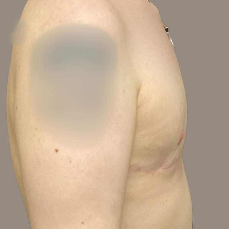 Female To Male Top Surgery 07