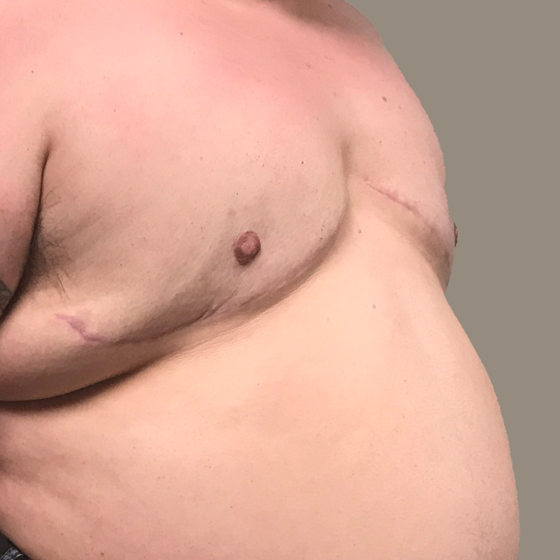 Female To Male Top Surgery 03