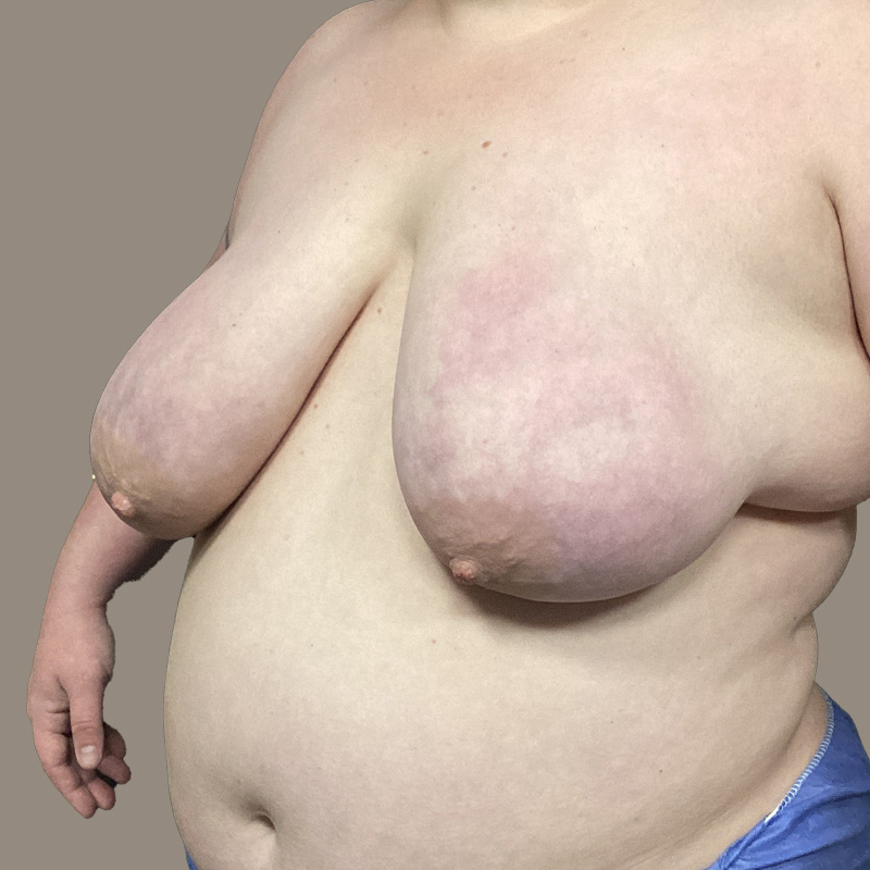 Female To Male Top Surgery 05