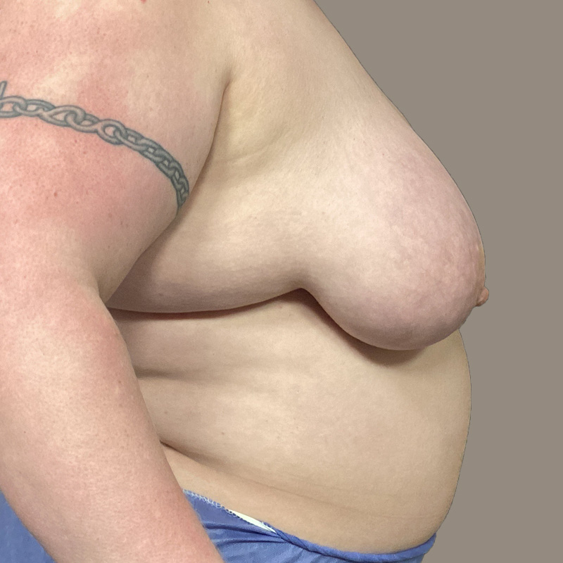 Female To Male Top Surgery 07