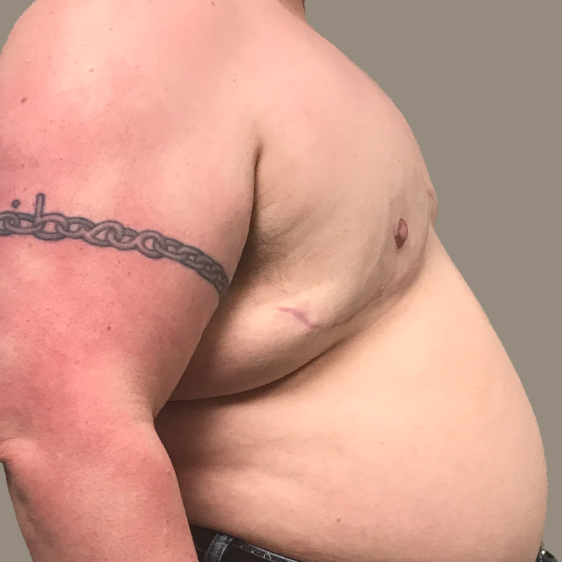 Female To Male Top Surgery 07