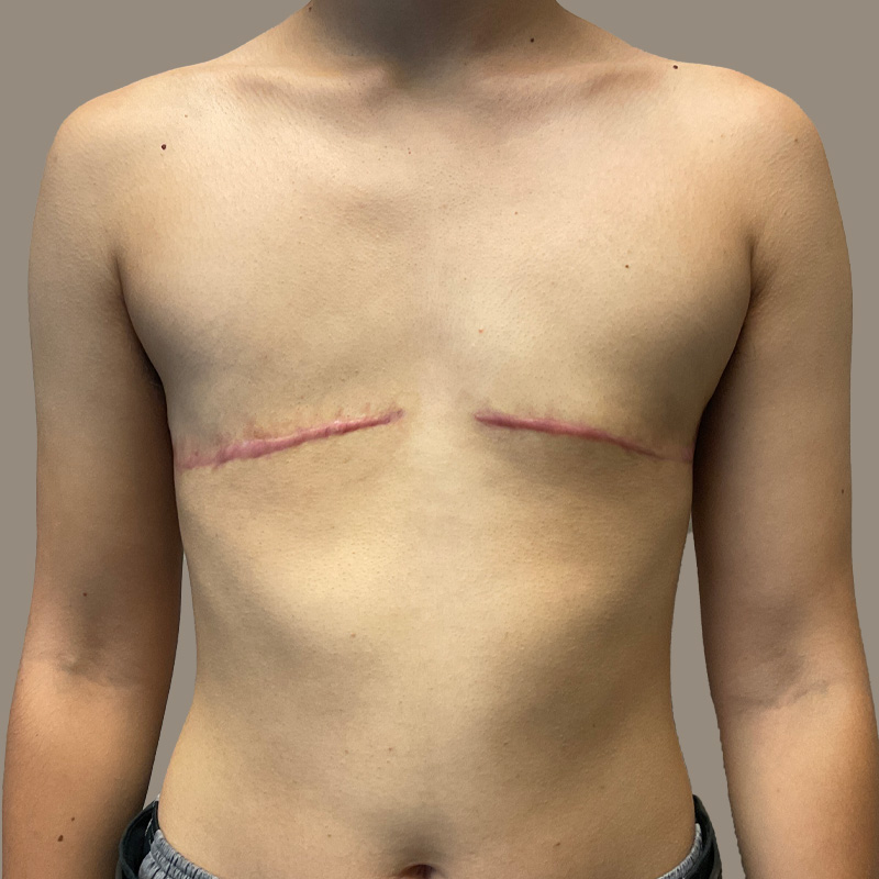 Female To Male Top Surgery 03