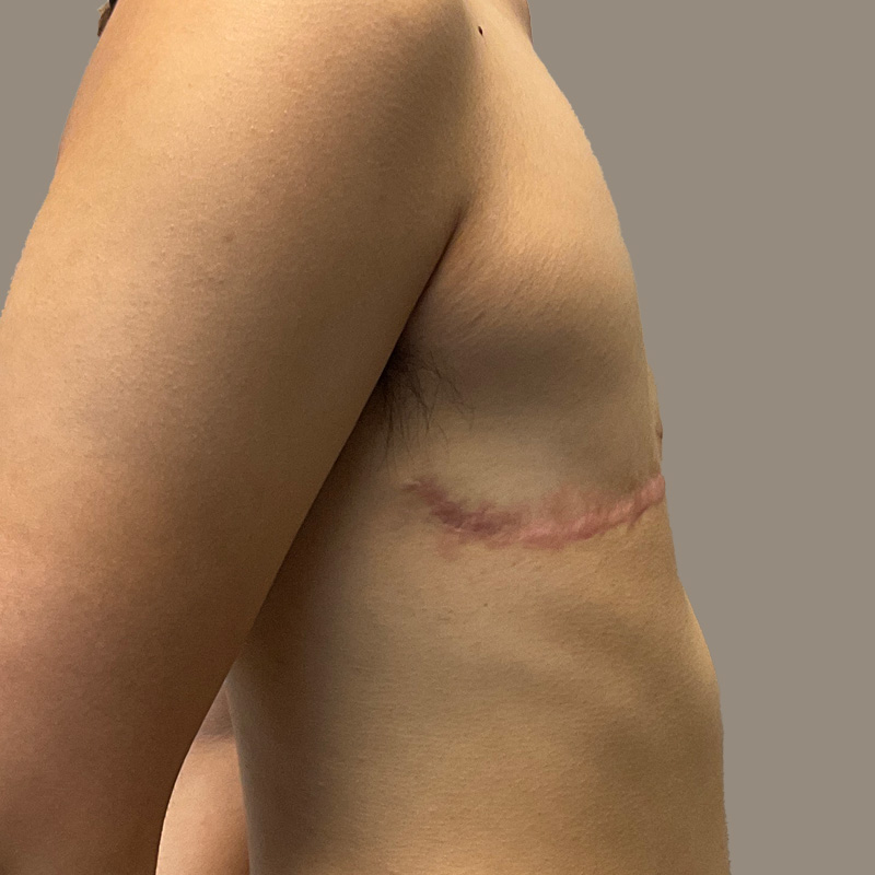 Female To Male Top Surgery 03