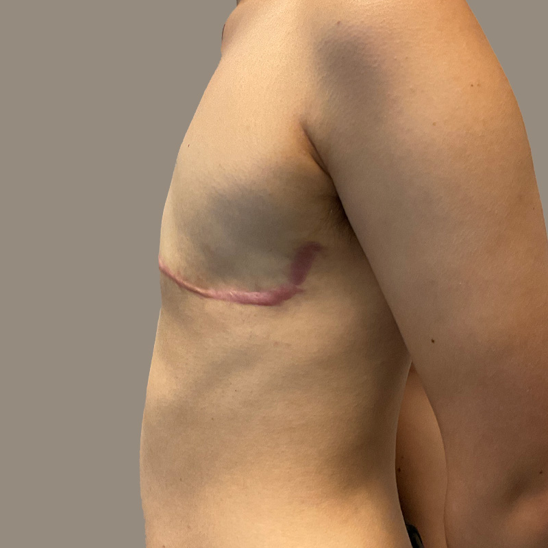 Female To Male Top Surgery 05