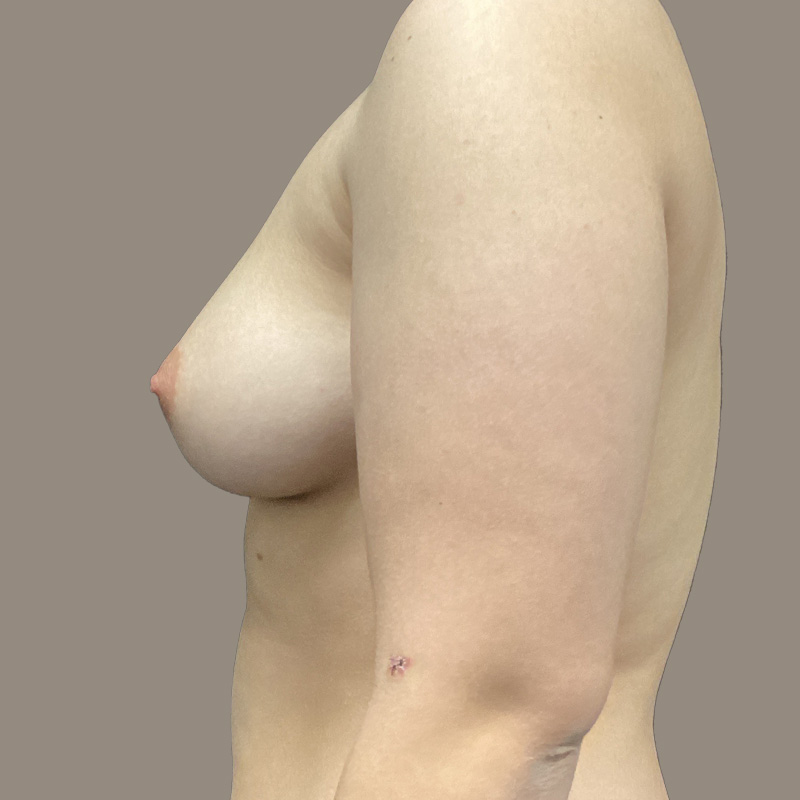 Female To Male Top Surgery 03