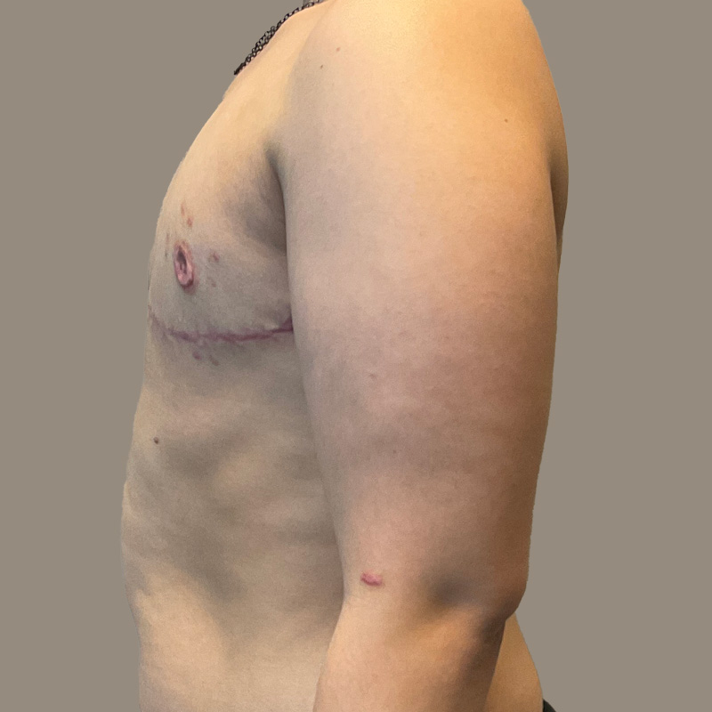 Female To Male Top Surgery 03