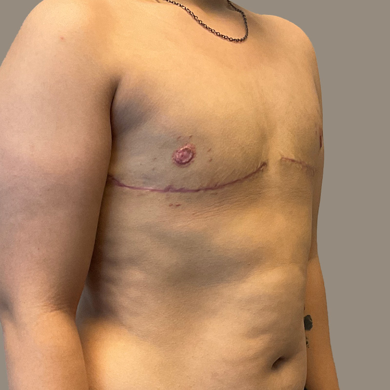 Female To Male Top Surgery 07