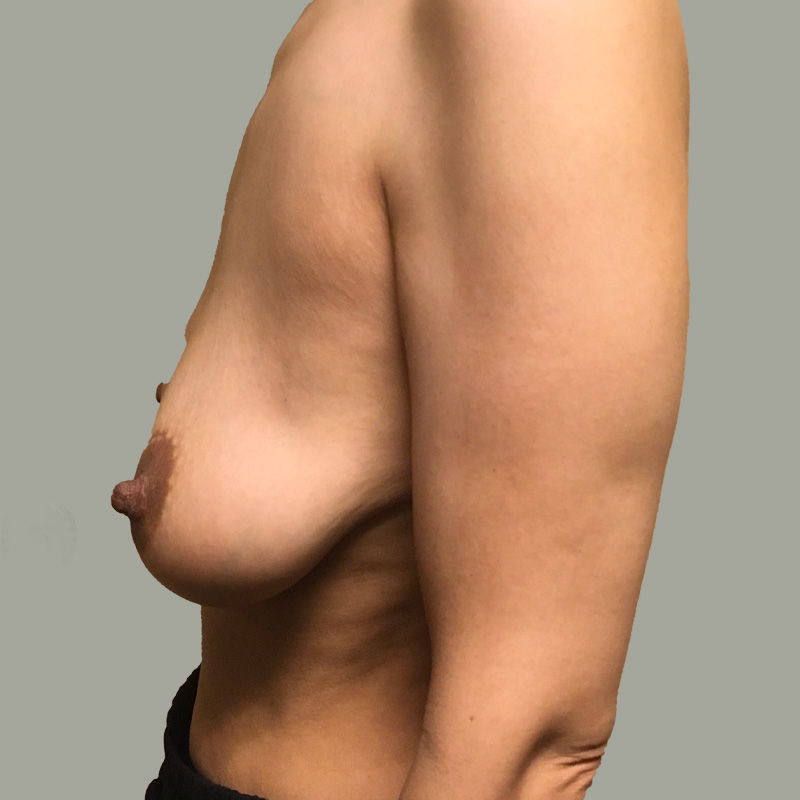 Female To Male Top Surgery 05