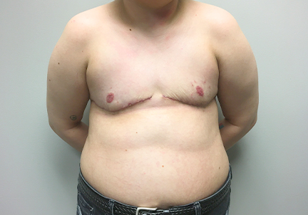 Female To Male Top Surgery 03