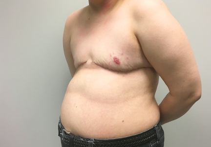 Female To Male Top Surgery 05