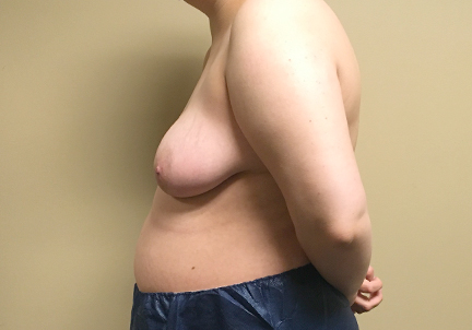 Female To Male Top Surgery 09