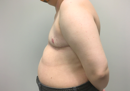 Female To Male Top Surgery 09