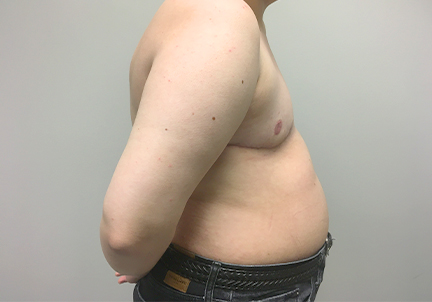 Female To Male Top Surgery 11