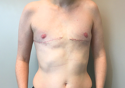 Female To Male Top Surgery 07