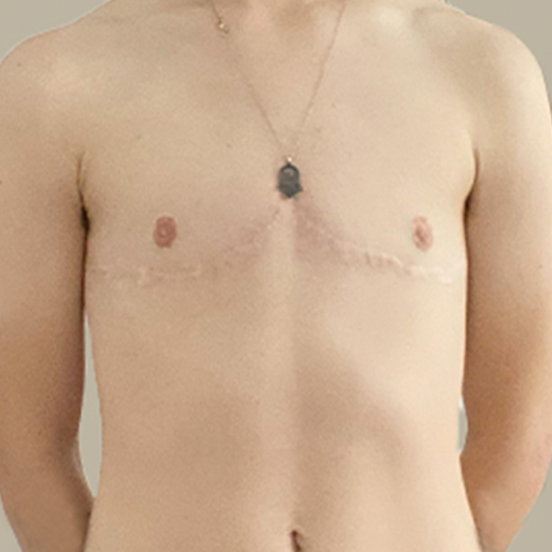 Female To Male Top Surgery 08