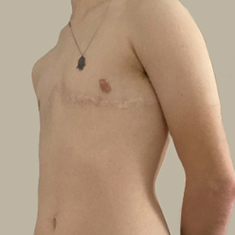 Female To Male Top Surgery 03