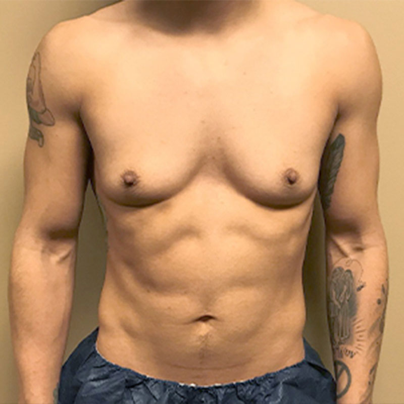 Female To Male Top Surgery 01