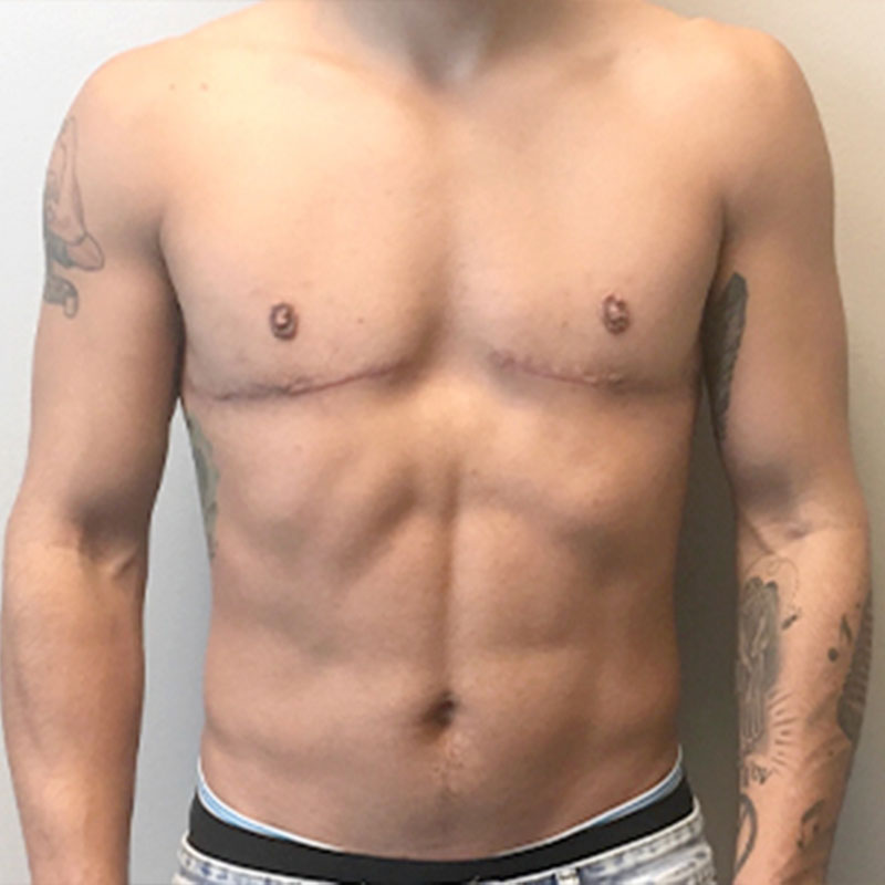 Female To Male Top Surgery 09