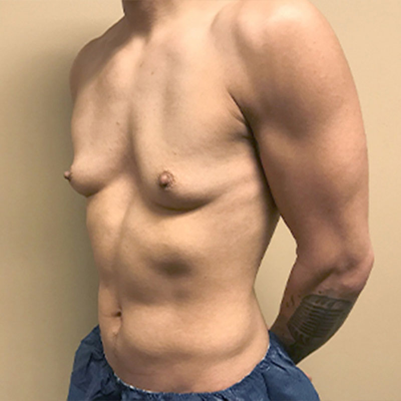 Female To Male Top Surgery 03