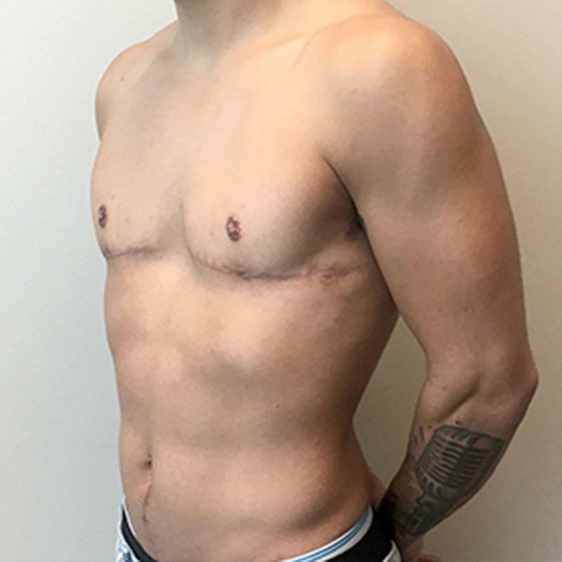 Female To Male Top Surgery 03