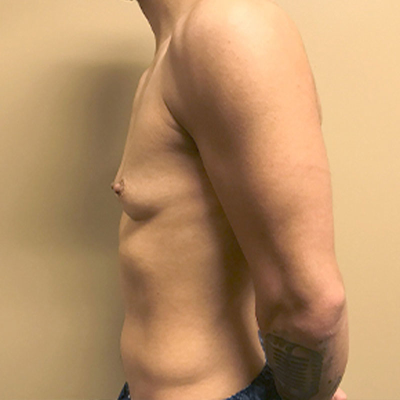 Female To Male Top Surgery 05