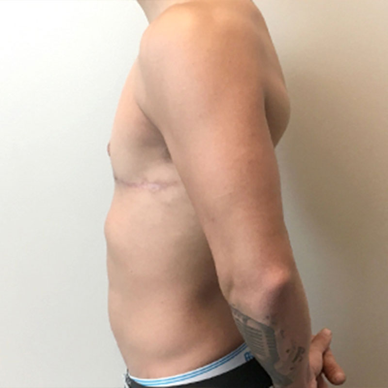 Female To Male Top Surgery 05