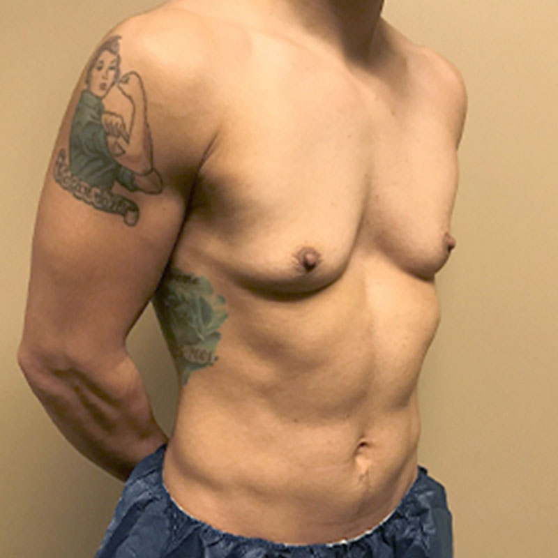 Female To Male Top Surgery 07