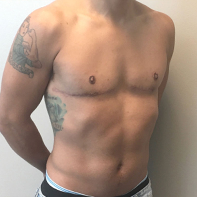 Female To Male Top Surgery 07