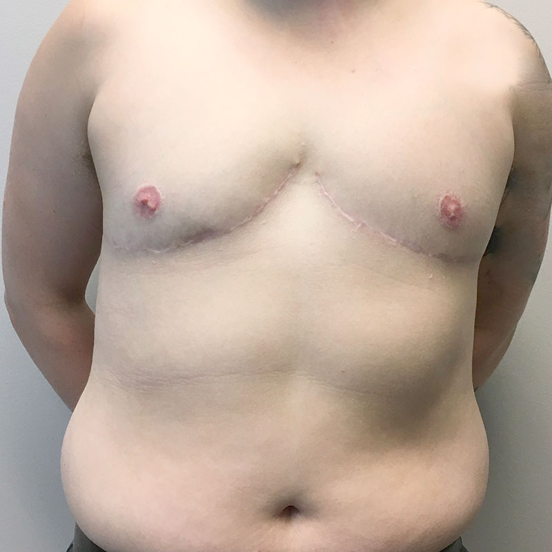 Female To Male Top Surgery 10