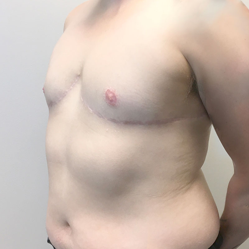 Female To Male Top Surgery 03