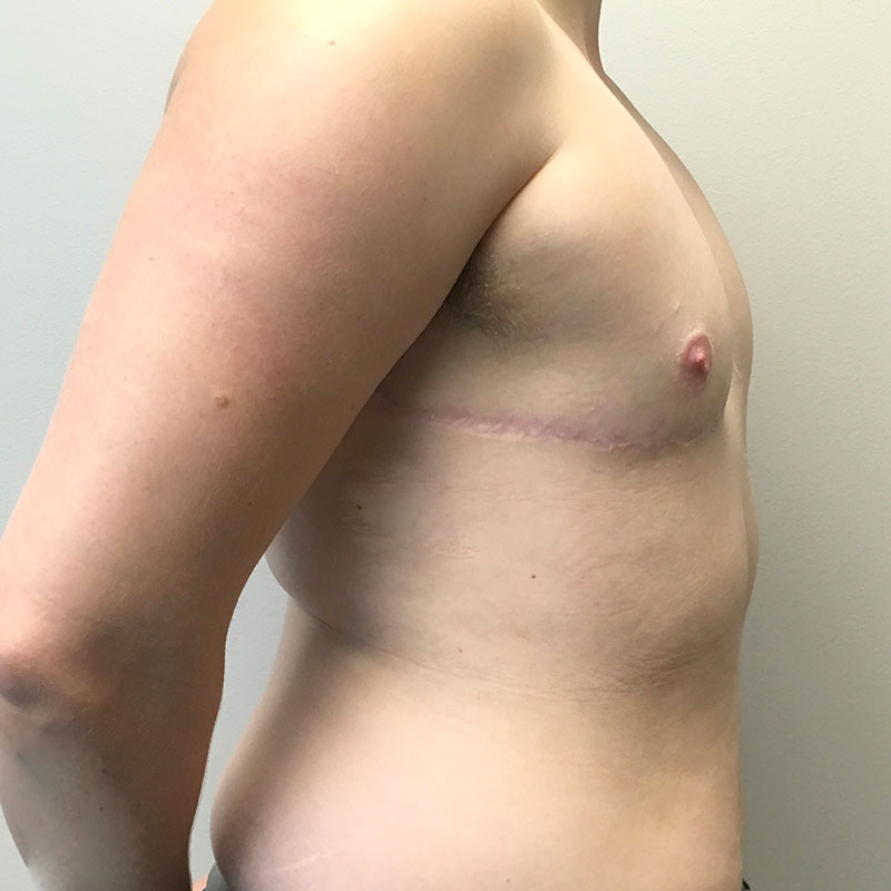 Female To Male Top Surgery 09